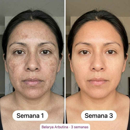 Belarya™ Elimina Manchas Faciales en 4 Semanas con Crema de Arbutina