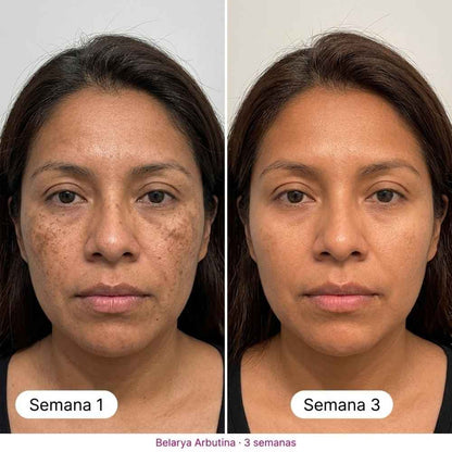 Belarya™ Elimina Manchas Faciales en 4 Semanas con Crema de Arbutina