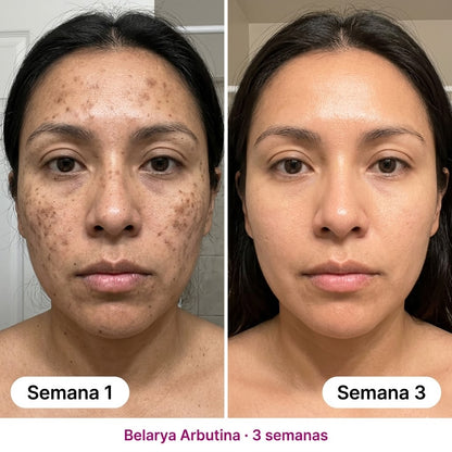 Belarya™ Elimina Manchas Faciales en 4 Semanas con Crema de Arbutina